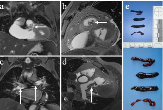Table 2 displays our experience of the strengths and weaknesses of both methods. Except for the visualization of internal livores within the lungs, we consider MRI as more precise and accurate compared to MSCT in the demonstration of physiological postmort