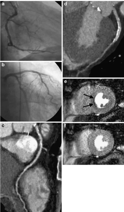 Fig. 1 Conventional coronary angiography rules out  signifi-cant stenosis in the right  coro-nary artery (RCA, a), the left anterior descending artery (LAD, b), and the circumflex artery in this 71-year-old male patient.