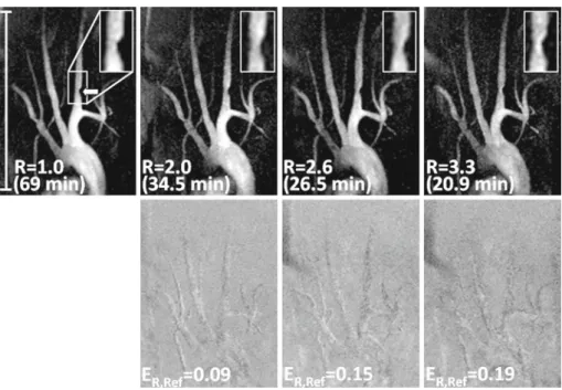 Fig. 1 Representative horizontal maximal intensity projections (MIPs) of mouse supra-aortic vessels for different acceleration factors R and corresponding difference images calculated with respect to the non-accelerated MIP (R = 1 