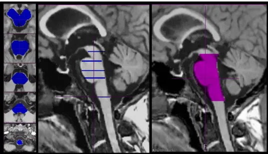 Fig. 1 The manually outlined contour of the midbrain, pons, and medulla on five slices superior and inferior to the peduncles (blue) is used for the subsequent automatic