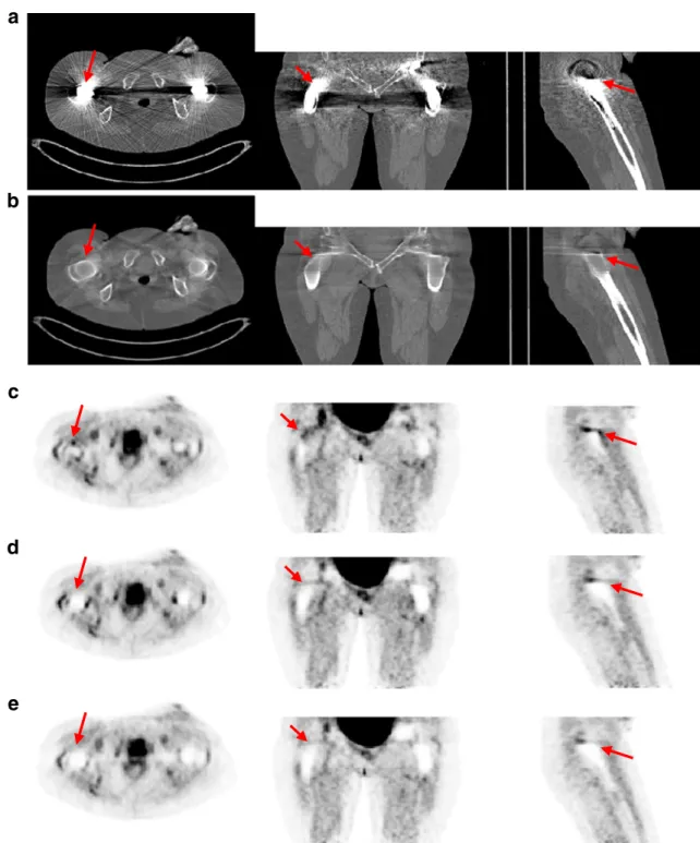 Figure 12a shows the mean tracer uptake of the uncorrected and corrected PET images using the proposed and Siemens MAR techniques for the overestimated, underestimated and unaffected regions