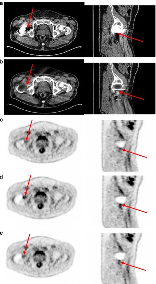 Fig. 9 Representative images of a second clinical study showing three planes of uncorrected (a) and corrected (b) CT images using the proposed MAR  meth-od