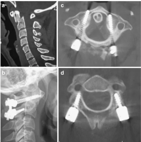 Fig. 1a – d A 27-year-old woman with painful  pseudo-arthrosis of a type II odontoid fracture after 3 months of rigid external immobilisation.