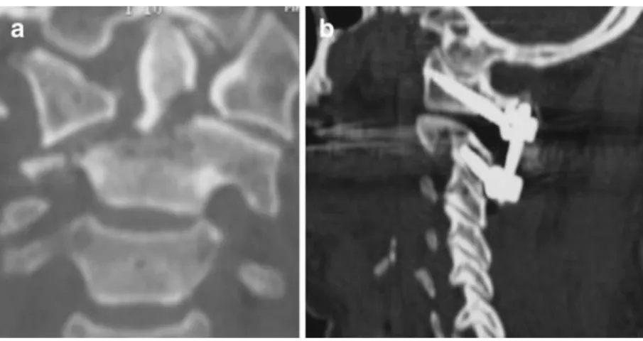 Fig. 4a – c A 60-year-old woman with C1-C2 instability of unknown origin. a Pre-operative lateral flexion-extension radiographs showing 8 mm of anterior translation of C1 in flexion