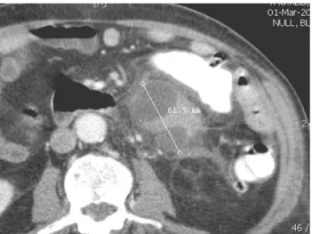 Fig. 2. Percutaneous drainage of diverticular abscess guided by com- com-puted tomography (CT) scan