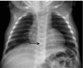 Fig. 2 US of the liver at 36 months of age. A new 2.7-cm hypoechoic liver lesion (arrow) and a large isoechoic liver lesion (asterisk) are detected