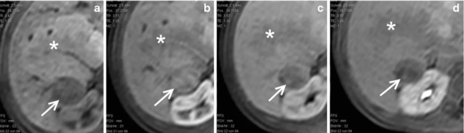 Fig. 4 MRI of the liver at 36 months of age. T1-W dynamic contrast- contrast-enhanced sequences with gadolinium