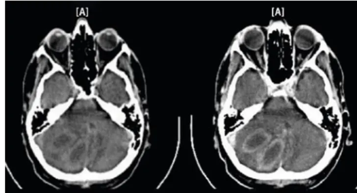 Abb. 1  7  CCT mit   Nachweis von 2 rand-ständig hyperdensen   und kontrastmittelauf-nehmenden (rechts)  Läsionen im rechten  Zerebellum 301Der Pathologe 4 · 2008  | 
