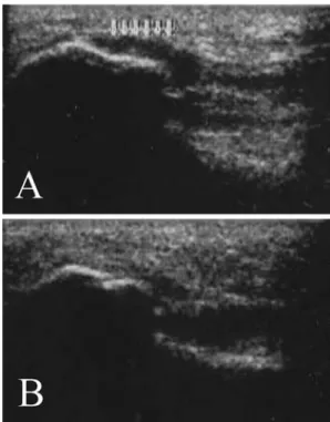 Fig. 3 a An ultrasound examination performed before starting ESWT treatment showing evidence of acute bursitis around the proximal insertion of the plantar fascia