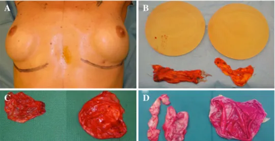 Fig. 2 a Representative case of a patient with grade 3 capsular contracture. b Partial