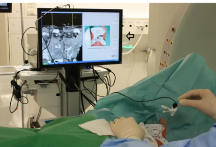 Fig. 2 Biopsy of a pararenal mass (tip of white line on the left side of the screen). On the screenshot of the navigation system, the yellow line depicts the needle and its actual position (yellow arrow), and the white line shows the planned needle path (w