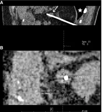 Fig. 3 A Final needle placement of the procedure depicted in Fig. 2 in the pararenal mass (white arrow)