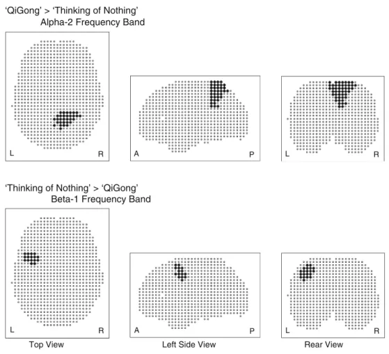 Fig. 1 Comparison of brain activity during ‘‘Qigong’’ and ‘‘Thinking of Nothing.’’ Glass brain views, from left to right: axial, sagittal, and coronal views