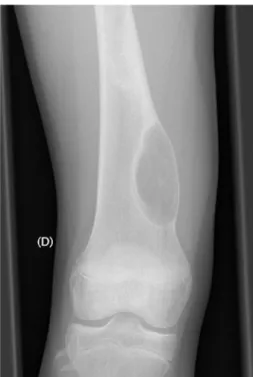 Fig. 11 However, 18 months after the operation, the patient pre- pre-sented with small, lytic, recurrent foci in the lower part of the old lesion