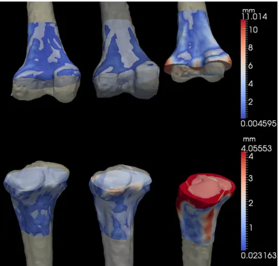 FIGURE 3. Three-dimensional view of a sample result. The surface distance between the template cut from the right bone and the left tibiae from the databank is represented as color-coded surface maps