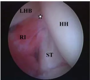Fig. 4 Arthroscopic view of a left shoulder. Note a very large, thickened long head biceps tendon (LHB) that was medially unstable