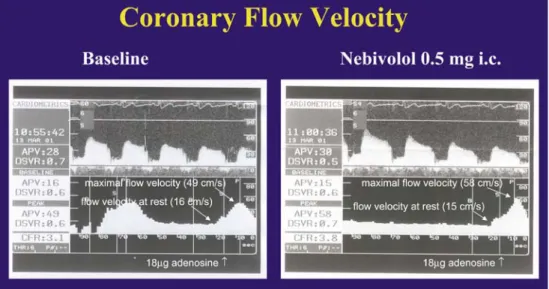 Fig. 2 Representative recordings of coronary flow velocity in a coronary artery disease patient before (left) and after 0.5 mg intracoronary nebivolol (right)