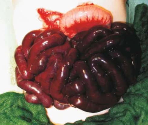 Fig. 3. Appearance of the small bowel on laparotomy 7 days later.