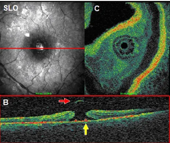Fig. 3 Full thickness macular hole lesion extent is displayed on the en-face confocal image (SLO); the C-scan (C) reveals a rosette of cystoid spaces  sur-rounding the defect