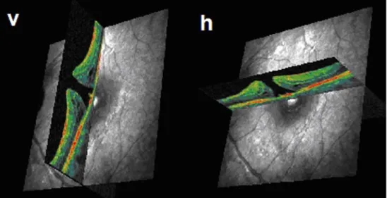 Fig. 4 Exact allocation of each B-scan optical coherence  to-mography (OCT) to the retinal surface displayed on the  scan-ning laser ophthalmoscopy (SLO) channel
