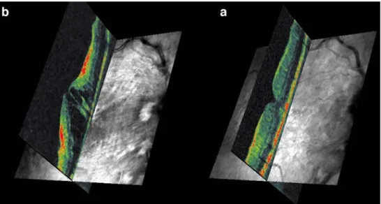 Fig. 7 200 subsequent C-scan optical coherence tomography (OCT) stacks produce actual retinal thickness maps without data  interpola-tion