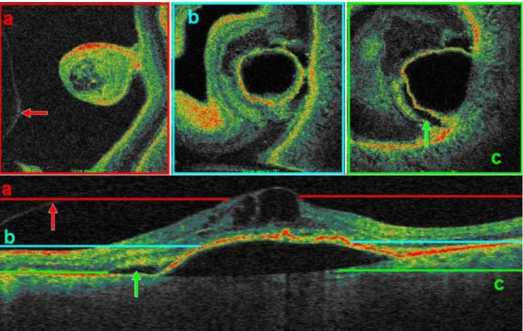 Fig. 8 we demonstrate how different scanning depths alter the aspect of C-scans: the coloured lines on the B-scan correspond to the matching C-scans above