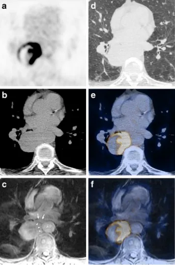 Fig. 2 A 52-year-old male patient suffering from metastasizing ma- ma-lignant melanoma: unenhanced low-dose CT image (a), T1w  fat-suppressed MR image (b), fused 18 F-FDG PET/CT image (c), PET/