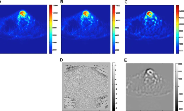 Figure 2 shows example clinical imaging of a pharyngolar- pharyngolar-yngeal squamous cell carcinoma comparing the target volume definitions obtained using the different segmentation methods with the histology serving as reference