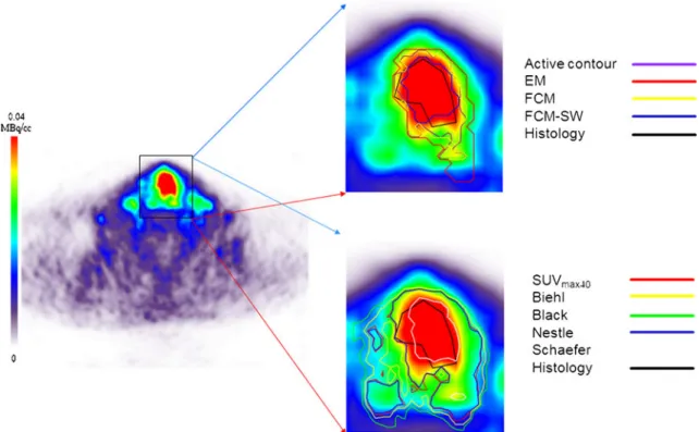 Fig. 3 Representative segmentation results for an FDG PET image in a patient presenting with histologically proven laryngeal squamous cell carcinoma to illustrate an extreme case of bad boundary estimation