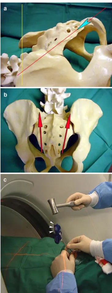 Fig. 1 a Schematic image using an artificial model of the hip in lateral view showing the tilting of the computed tomography (CT) gantry for positioning the sacroplasty needles