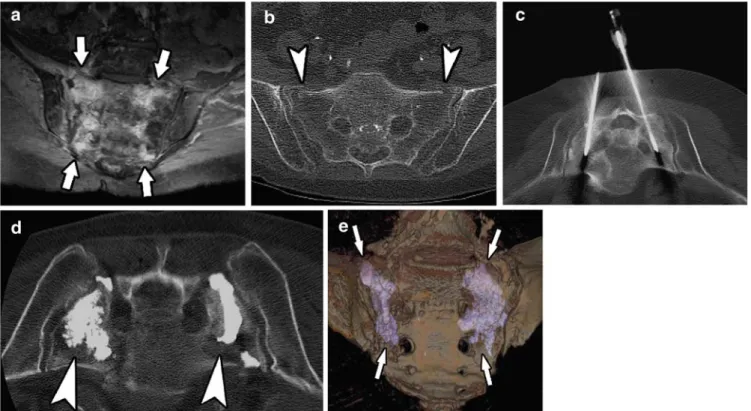 Fig. 2 a Axial T2-weighted magnetic resonance image (MRI) showing bone marrow edema within both sacral wings  correspond-ing to the fracture sites ( arrows )