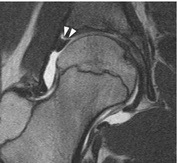 Fig. 1 Labral tear/detachment. MR arthrography of a 13-year-old boy with right-sided groin pain