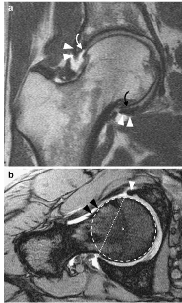 Fig. 3 Cam-type of femoroacetabular impingement (FAI). a On the coronal T1-weighted spin echo images (MR arthrogram obtained after injection of 10 ml of 2 mmol/l gadopentetate) superolateral labral detachment (arrowhead) and an adjacent cartilage defect at