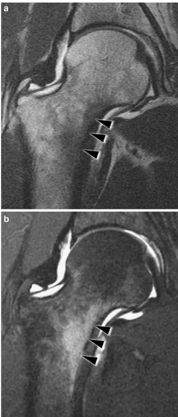 Fig. 6 Femoral neck stress reaction. MR arthrogram with a coronal T1-weighted spin echo image and b fat-suppressed T2-weighted turbo spin echo image