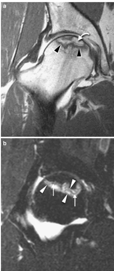 Fig. 7 MR arthrography findings in avascular necrosis of the femoral head. a On the T1-weighted spin echo image a serpiginous line of low signal (arrowheads) surrounding an area of fatty marrow (curved arrow) is seen anterosuperiorly