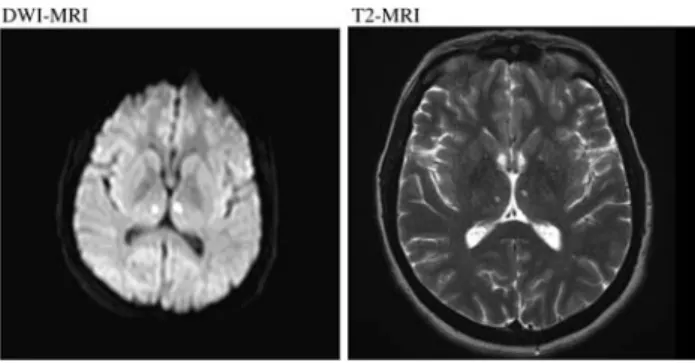 Fig. 1 Diffusion weighted (DWI) and T2 MRI sequences of the brain showing acute bilateral paramedian ischemic lesions