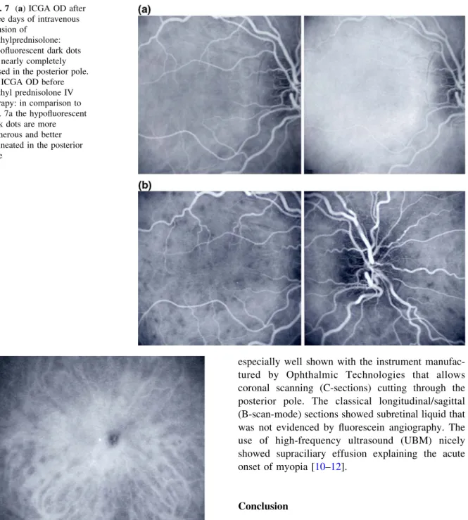 Fig. 8 Wide-angle ICGA OD: this wide-angle ICGA frame clearly shows that the hypofluorescence is still present in the periphery after three days of IV methylprednisolone therapy