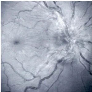 Fig. 1 Red-free photograph of the posterior pole of the right eye showing disc swelling