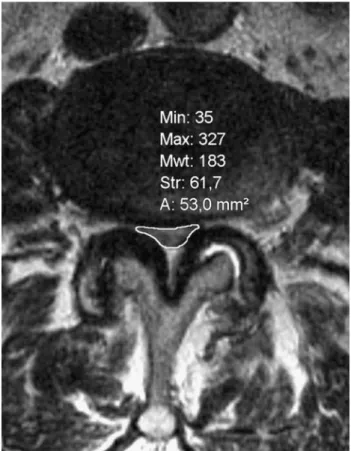 Fig. 1 Determination of the smallest area of the dural sac and the neuroforaminal area