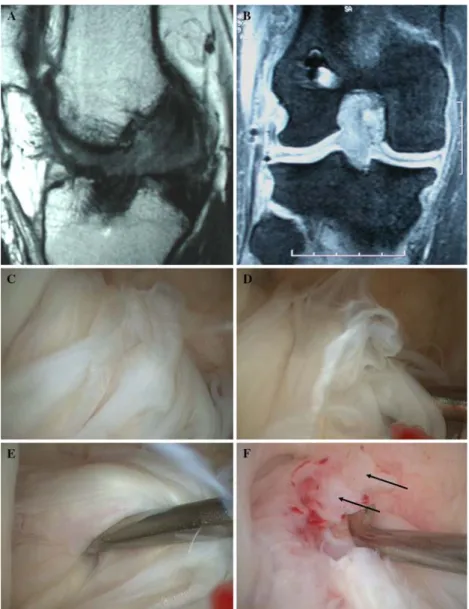 Fig. 2 Anterior cruciate ligament (ACL) graft 1 year post-implantation in a professional football player abusing of drugs (cocaine, amphetamine, methadone)
