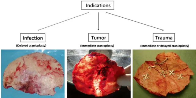 Fig. 1 Intraoperative template-molded bone flap reconstruction for patient-specific cranioplasty can be performed after bone flap loss due to infection, tumor invasion, or comminuted fractures