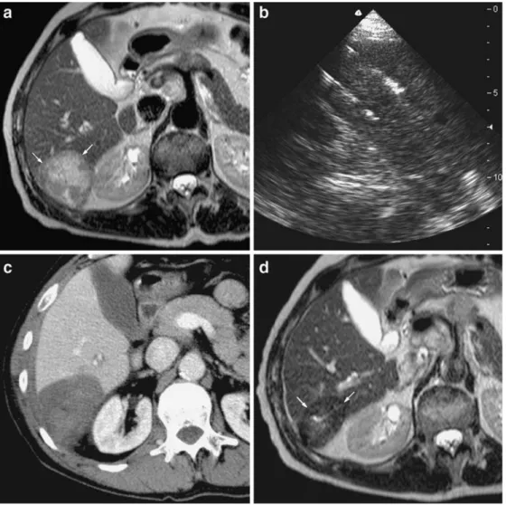 Fig. 1 Large hepatic metastasis from bronchogenic carcinoma close to the right kidney in a 53-year-old male after left pneumectomy.