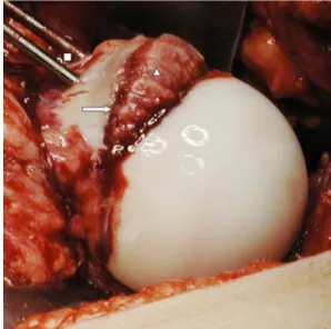 Table 3. Crosstable of physeal integrity and the acute/chronic clas- clas-sification in 82 hips Acute or acute-on-chronic Intraoperative physealintegrity disrupted Total Yes No Yes 23 (82%*) 30 (56%) 53 No 5 (18%) 24 (44%**) 29 Total 28 54 82 * Sensitivity