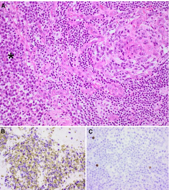 Fig. 1 Lymph node histology showing: a a lymph follicle with a regressed germinal center and radially penetrating blood vessels (right), accompanied by an increased interfollicular plasma cell content (asterisk);