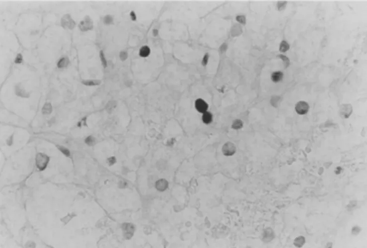 Fig. 1  Immunostaining  of mdm-2.  Renal  cell carcinoma  showing  nuclear staining, x560 