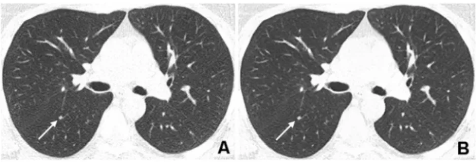 Fig. 3 Corresponding transverse CT images acquired with a tube voltage of 100 kVp and reference tube current-time product of 30 mAs in a 52-year-old obese (BMI 31.2 kg/m 2 ) female patient referred to CT for follow-up of pulmonary nodules