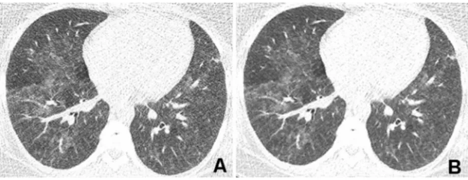 Fig. 5 Corresponding transverse CT images acquired with a tube voltage of 80 kVp and reference tube current-time product of 30 mAs in a 34-year-old obese (BMI 35.0 kg/m 2 ) female patient with immunodeficiency referred for CT to rule out pulmonary infectio