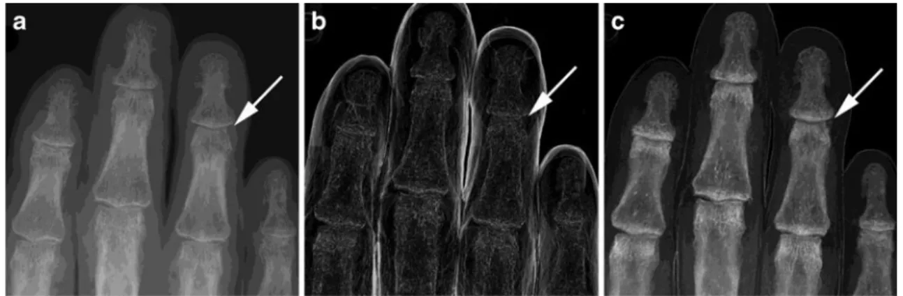 Fig. 5 Fusion of the standard absorption radiograph with the PC image, using different values for the fusion parameter alpha (see S2 of the supplemental material)