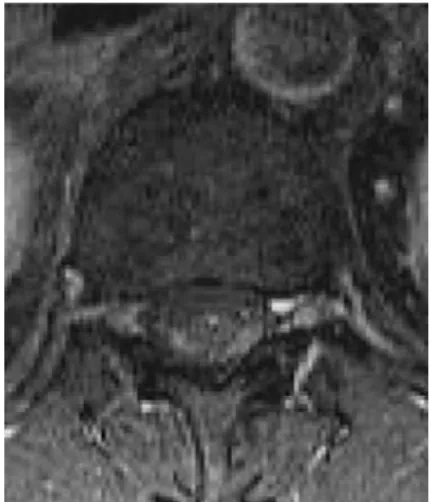 Fig. 1 Axial T1-weighted MRI of lumbar spinal cord after gadolinium showed an increased signal in perimedullary regions