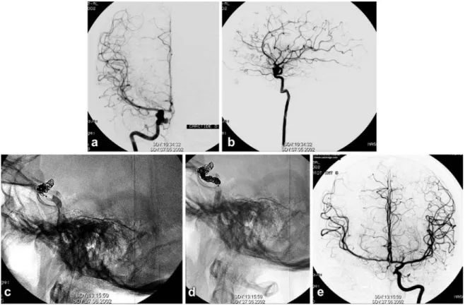 Fig. 2 A AP view, B lateral view. Cerebral digital subtraction angiography showed a small carotid cavernous aneurysm and adjacent intradural ophthalmic aneurysm with a multilobular and irregular appearance of the right internal carotid artery